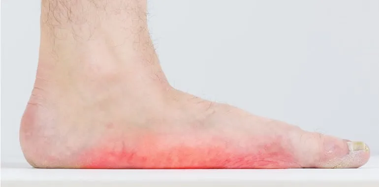Close-up of a bare foot showing the arch
